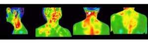 Neck and Back Scans - Thermal Imaging Texas - Angel Marlow - Houston, TX - Thermography - Holistic Health - Disease Prevention